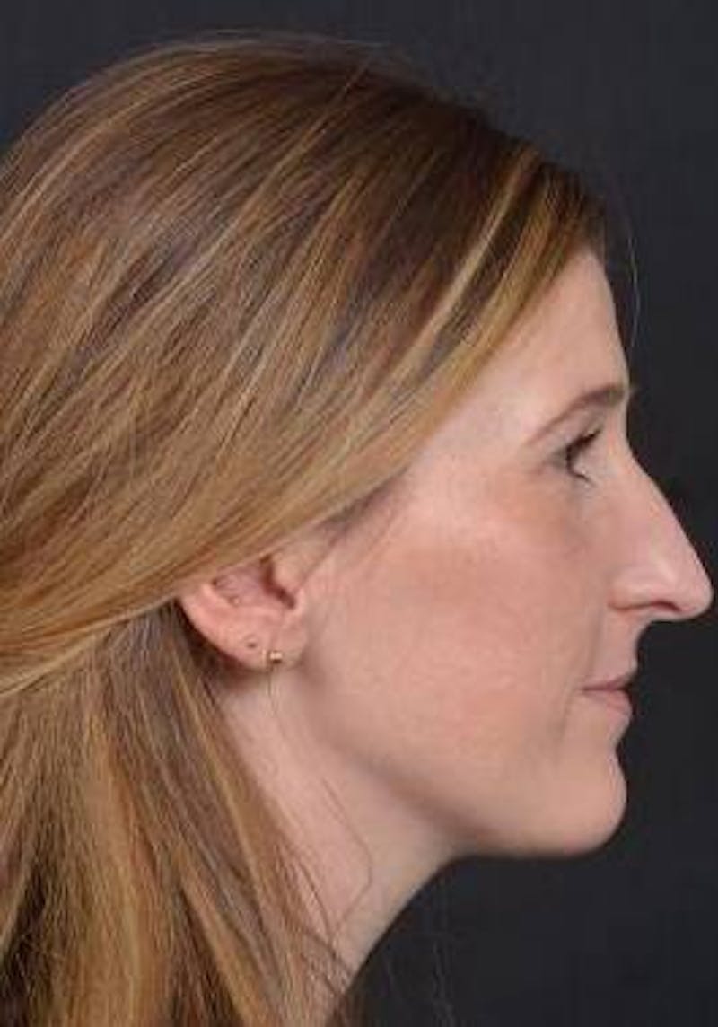 Rhinoplasty Before & After Gallery - Patient 251544 - Image 5