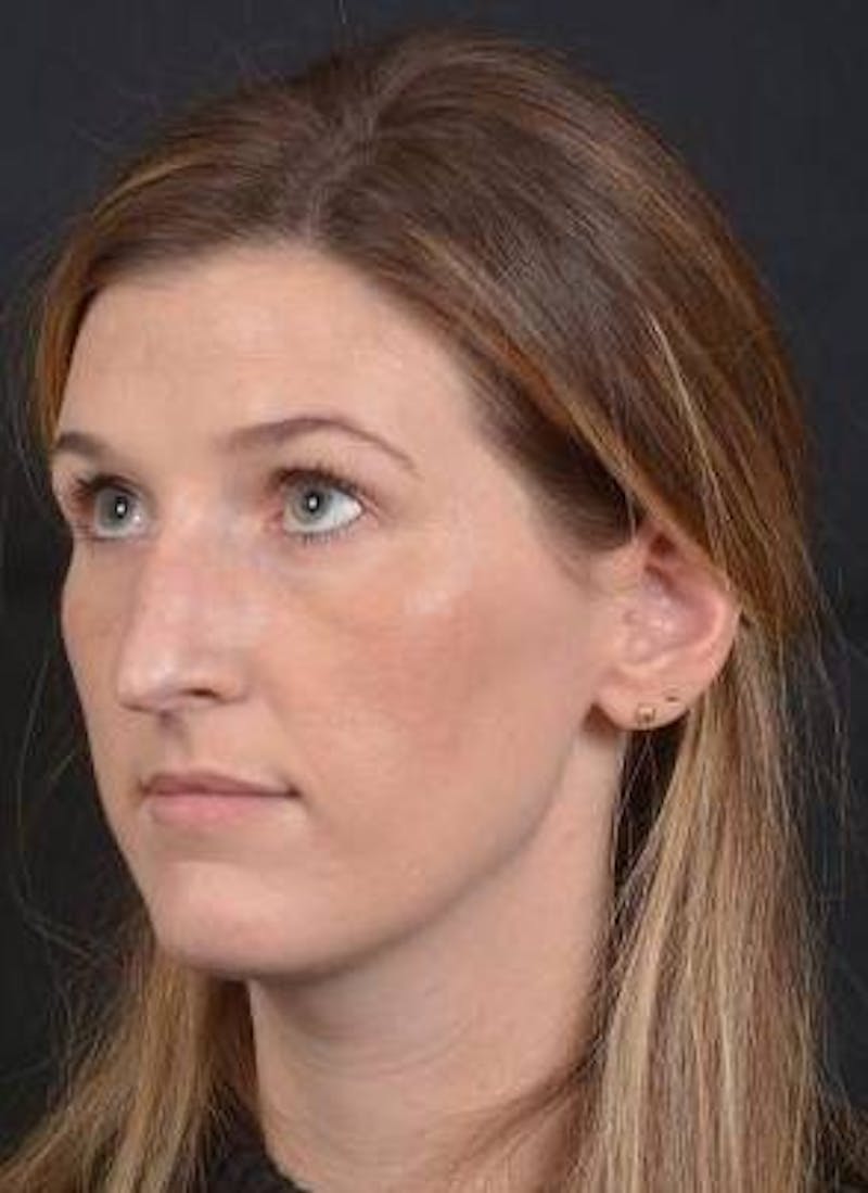 Rhinoplasty Before & After Gallery - Patient 251544 - Image 7