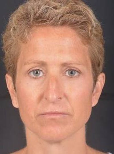 Rhinoplasty Before & After Gallery - Patient 394002 - Image 1