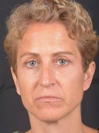 Rhinoplasty Before & After Gallery - Patient 394002 - Image 2