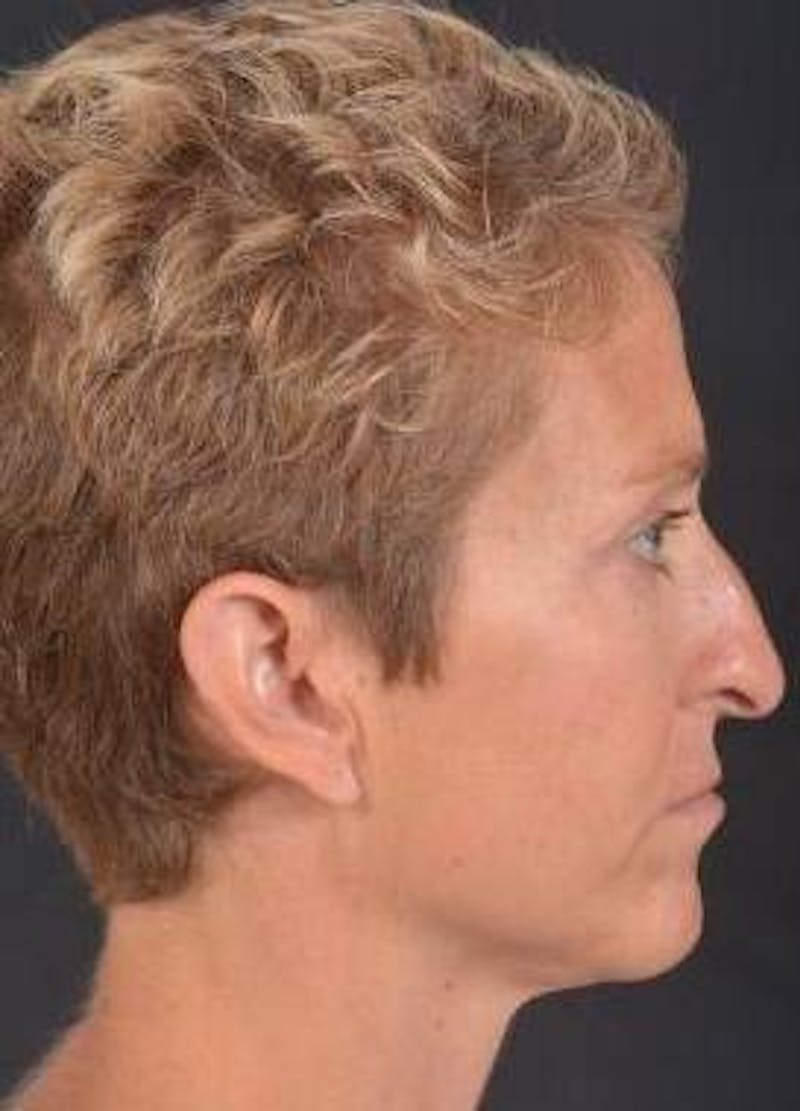 Rhinoplasty Before & After Gallery - Patient 394002 - Image 5