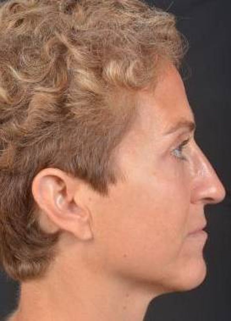 Rhinoplasty Before & After Gallery - Patient 394002 - Image 6