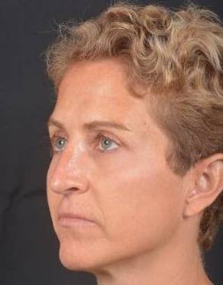 Rhinoplasty Before & After Gallery - Patient 394002 - Image 8