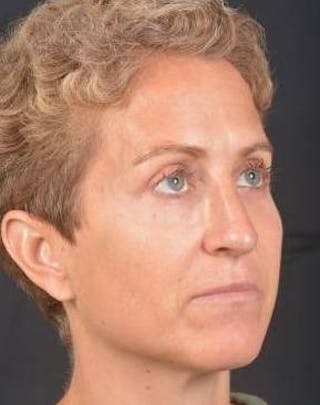 Rhinoplasty Before & After Gallery - Patient 394002 - Image 10