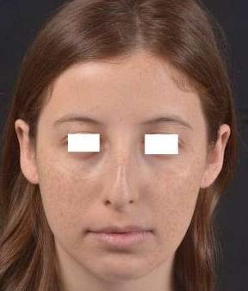 Rhinoplasty Before & After Gallery - Patient 222295 - Image 1