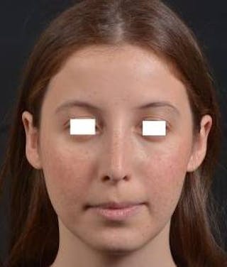 Rhinoplasty Before & After Gallery - Patient 222295 - Image 2