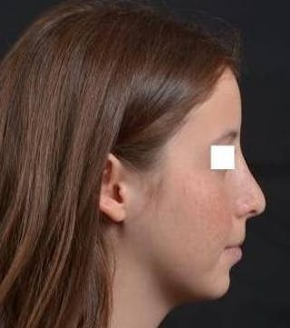 Rhinoplasty Before & After Gallery - Patient 222295 - Image 6