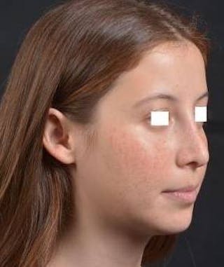 Rhinoplasty Before & After Gallery - Patient 222295 - Image 10