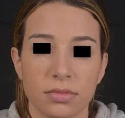 Rhinoplasty Before & After Gallery - Patient 156464 - Image 1