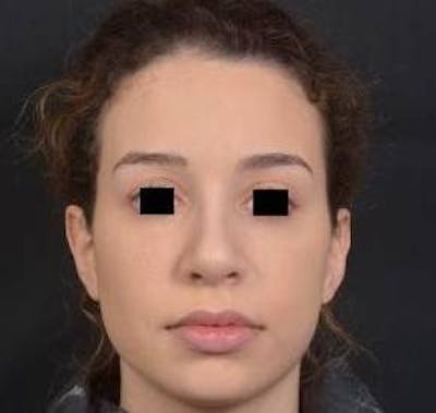 Rhinoplasty Before & After Gallery - Patient 156464 - Image 2