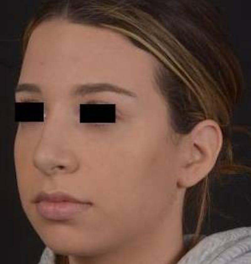 Rhinoplasty Before & After Gallery - Patient 156464 - Image 7