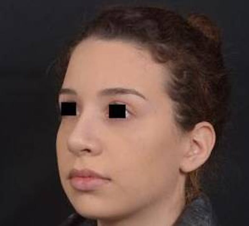 Rhinoplasty Before & After Gallery - Patient 156464 - Image 8