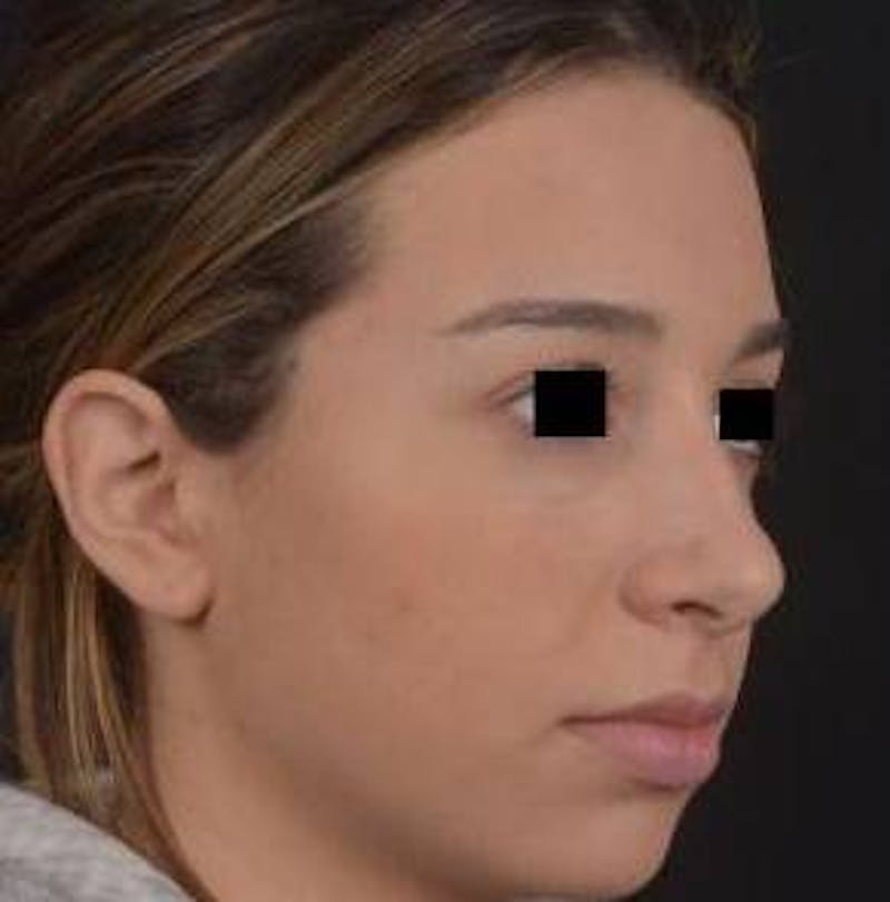 Rhinoplasty Before & After Gallery - Patient 156464 - Image 9