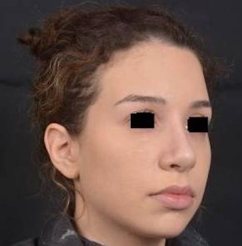 Rhinoplasty Before & After Gallery - Patient 156464 - Image 10