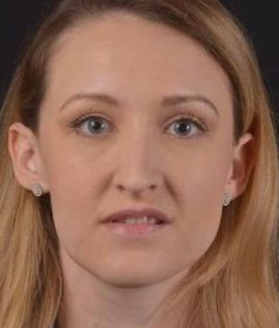 Rhinoplasty Before & After Gallery - Patient 407500 - Image 1
