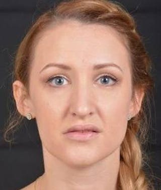 Rhinoplasty Before & After Gallery - Patient 407500 - Image 2