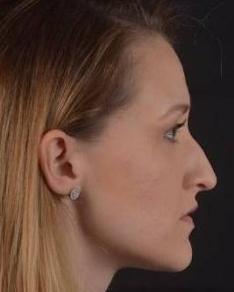 Rhinoplasty Before & After Gallery - Patient 407500 - Image 5