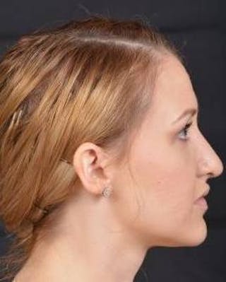 Rhinoplasty Before & After Gallery - Patient 407500 - Image 6