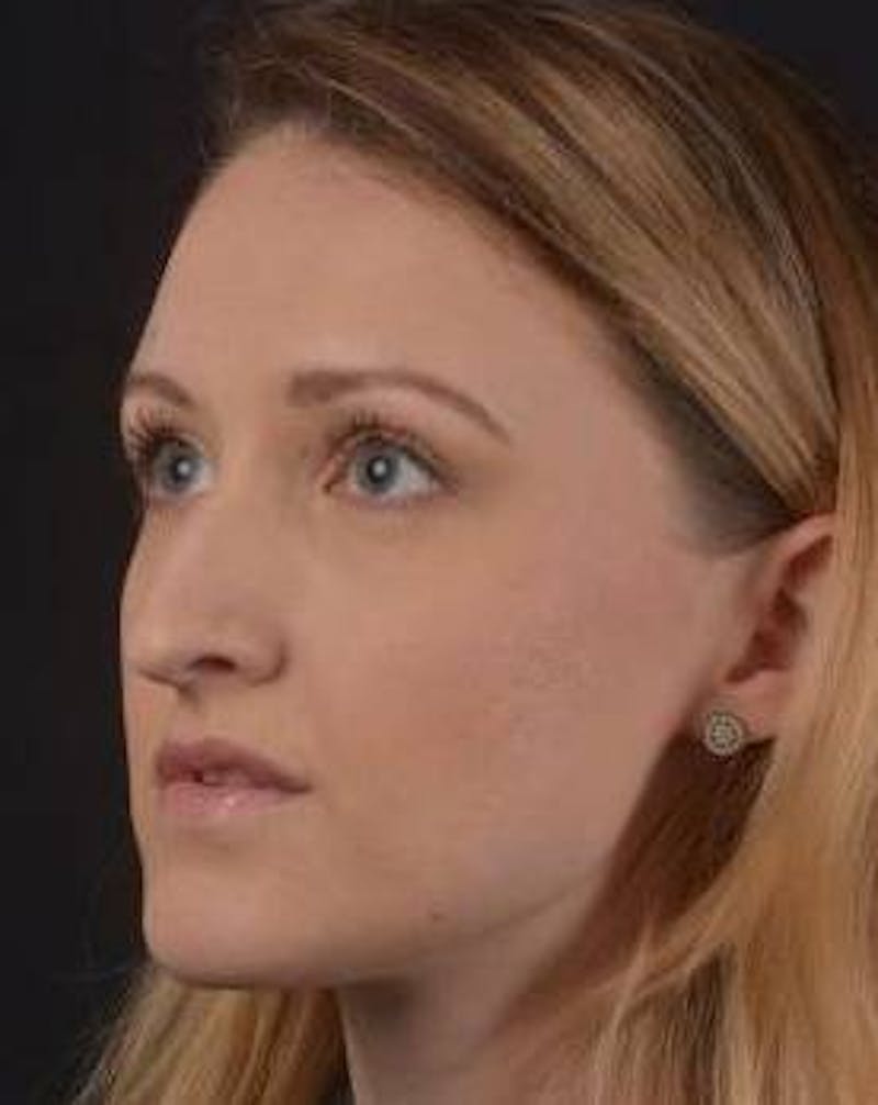 Rhinoplasty Before & After Gallery - Patient 407500 - Image 7