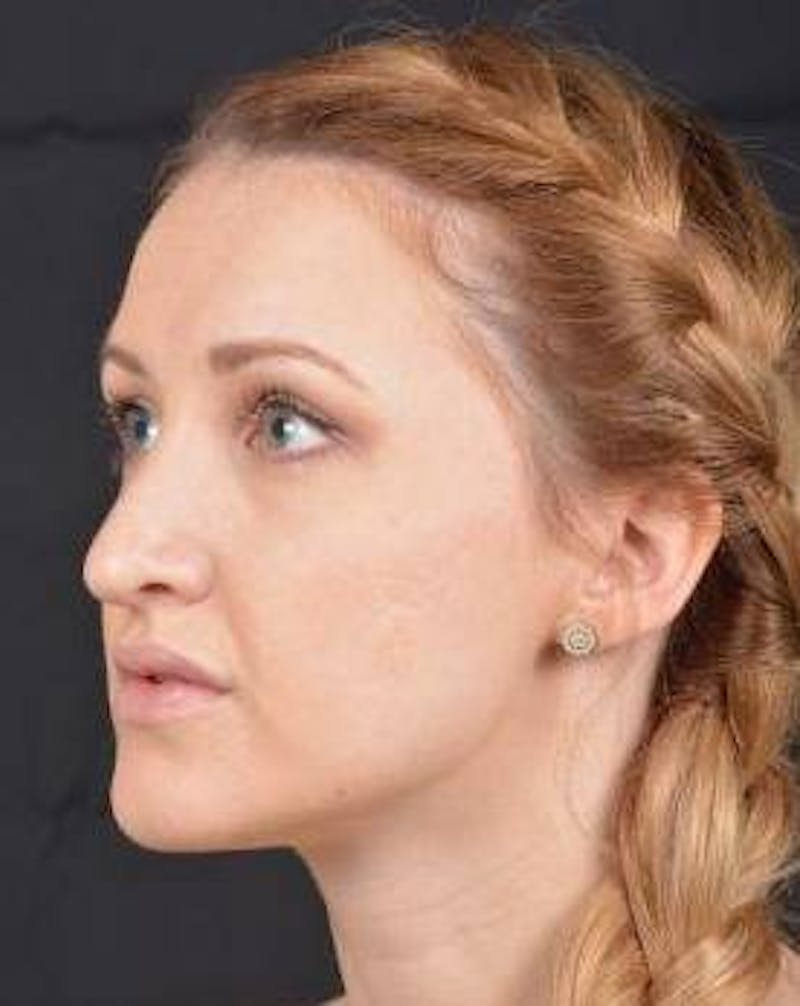 Rhinoplasty Before & After Gallery - Patient 407500 - Image 8