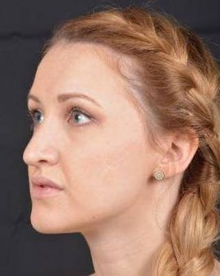 Rhinoplasty Before & After Gallery - Patient 407500 - Image 8