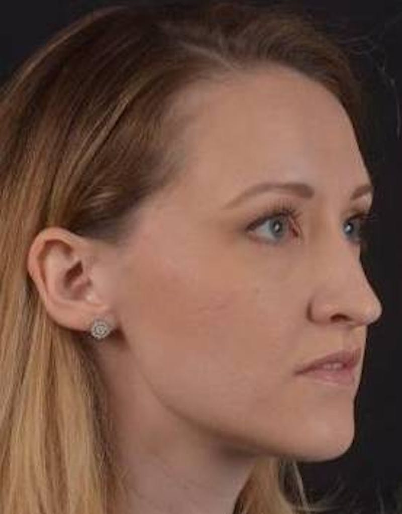 Rhinoplasty Before & After Gallery - Patient 407500 - Image 9