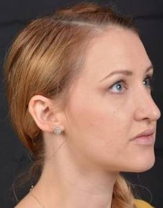 Rhinoplasty Before & After Gallery - Patient 407500 - Image 10