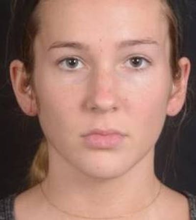 Rhinoplasty Before & After Gallery - Patient 273786 - Image 1