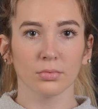 Rhinoplasty Before & After Gallery - Patient 273786 - Image 2