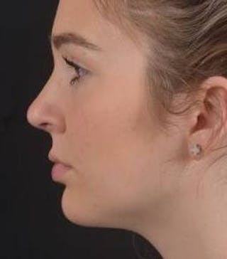 Rhinoplasty Before & After Gallery - Patient 273786 - Image 4