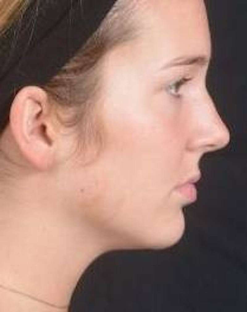 Rhinoplasty Before & After Gallery - Patient 273786 - Image 5