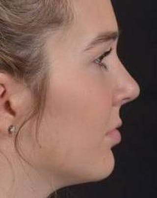 Rhinoplasty Before & After Gallery - Patient 273786 - Image 6