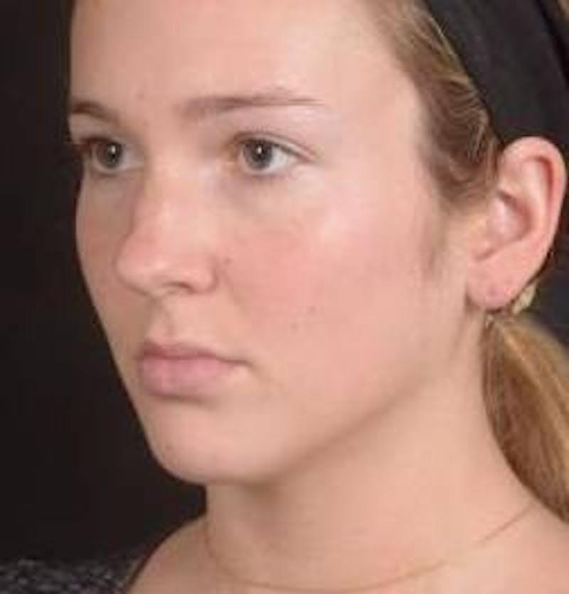 Rhinoplasty Before & After Gallery - Patient 273786 - Image 7