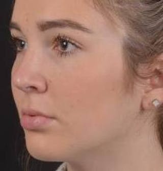Rhinoplasty Before & After Gallery - Patient 273786 - Image 8