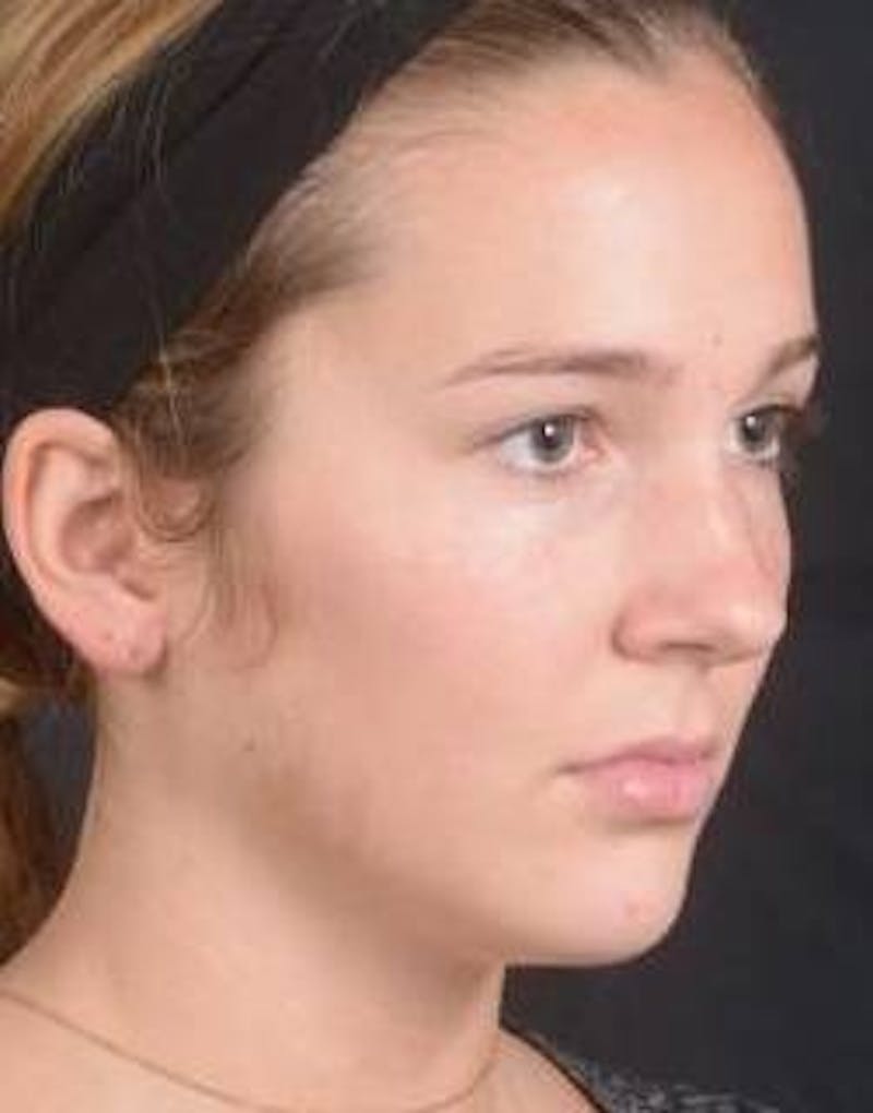 Rhinoplasty Before & After Gallery - Patient 273786 - Image 9