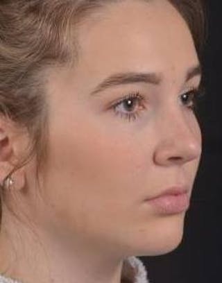 Rhinoplasty Before & After Gallery - Patient 273786 - Image 10