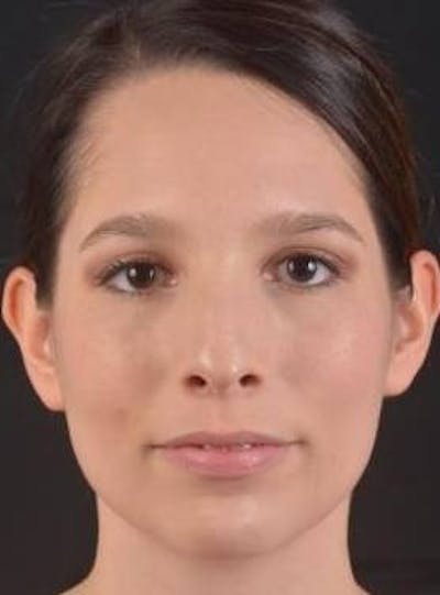 Rhinoplasty Before & After Gallery - Patient 411184 - Image 1