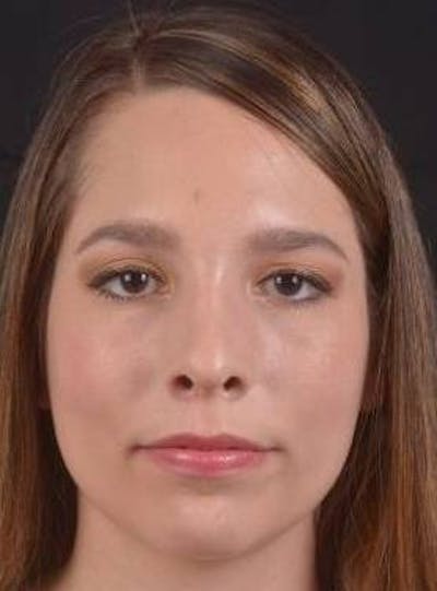 Rhinoplasty Before & After Gallery - Patient 411184 - Image 2