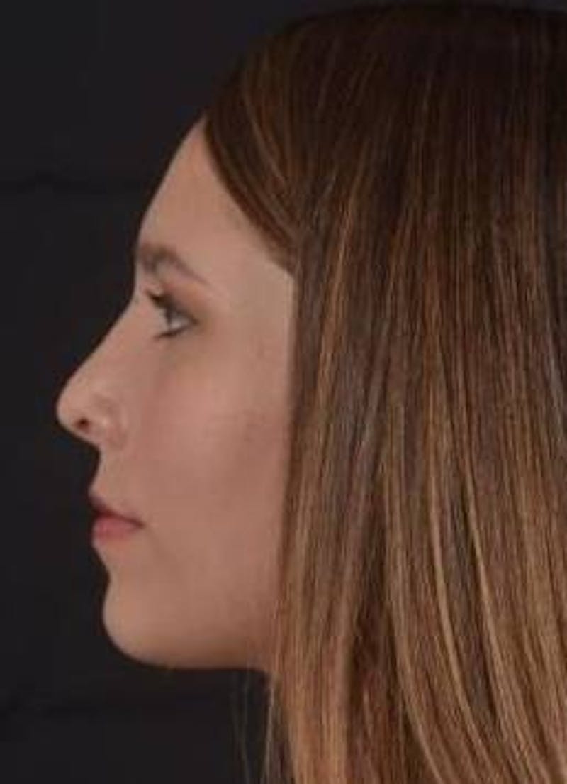 Rhinoplasty Before & After Gallery - Patient 411184 - Image 4
