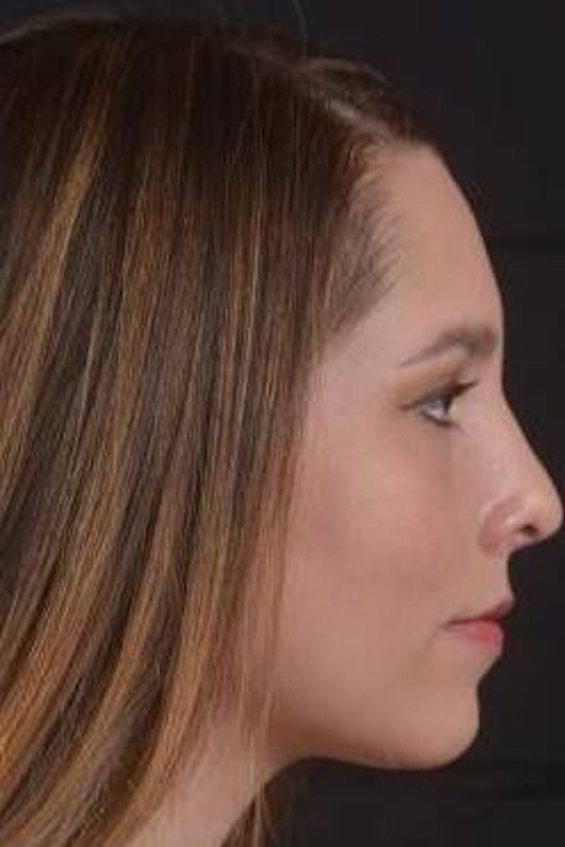 Rhinoplasty Before & After Gallery - Patient 411184 - Image 6