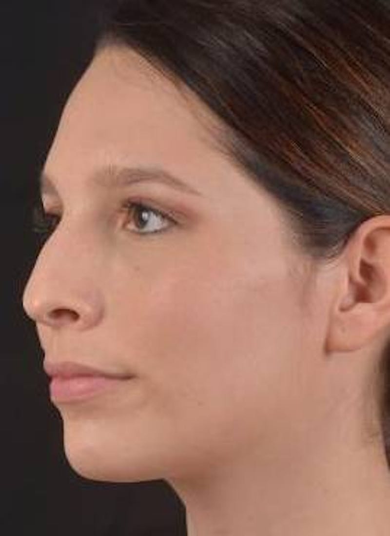 Rhinoplasty Before & After Gallery - Patient 411184 - Image 7