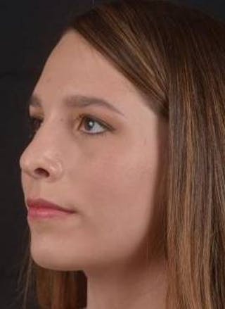 Rhinoplasty Before & After Gallery - Patient 411184 - Image 8