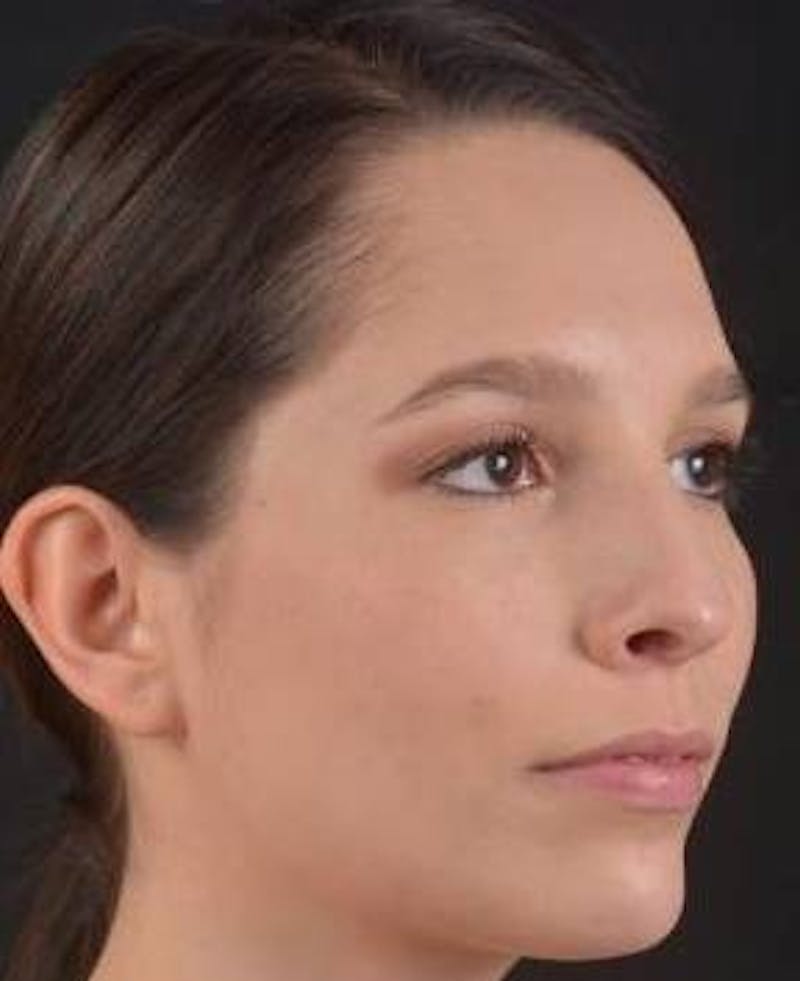 Rhinoplasty Before & After Gallery - Patient 411184 - Image 9