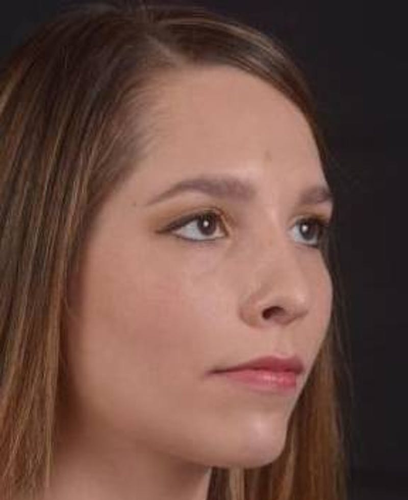 Rhinoplasty Before & After Gallery - Patient 411184 - Image 10