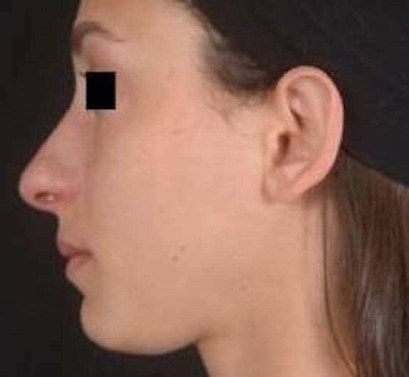 Rhinoplasty Before & After Gallery - Patient 111055 - Image 3