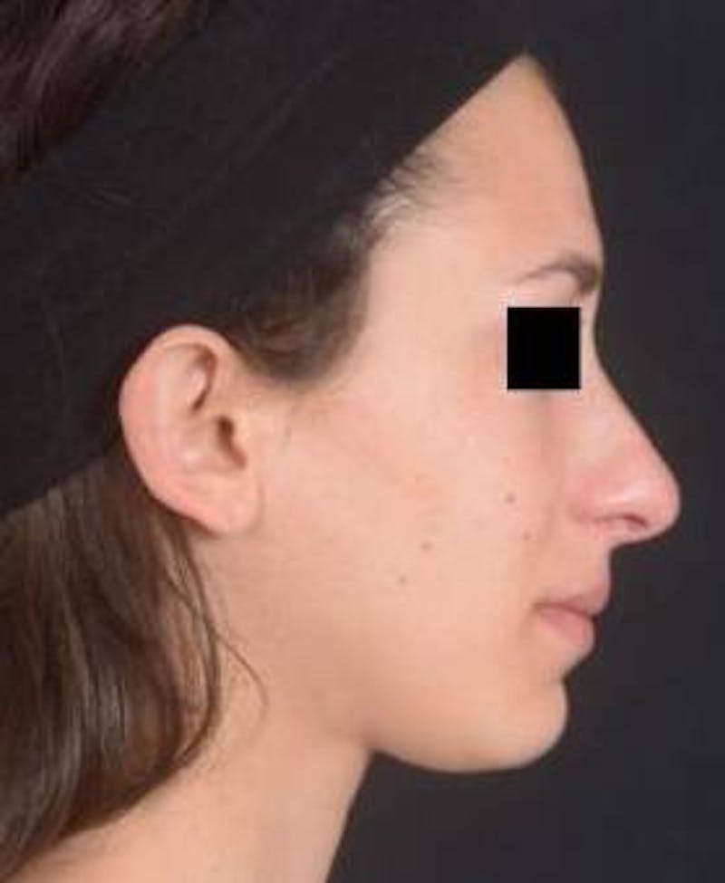 Rhinoplasty Before & After Gallery - Patient 111055 - Image 5