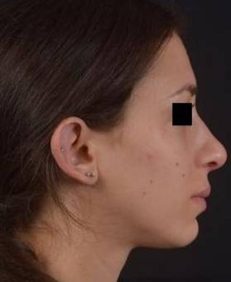 Rhinoplasty Before & After Gallery - Patient 111055 - Image 6