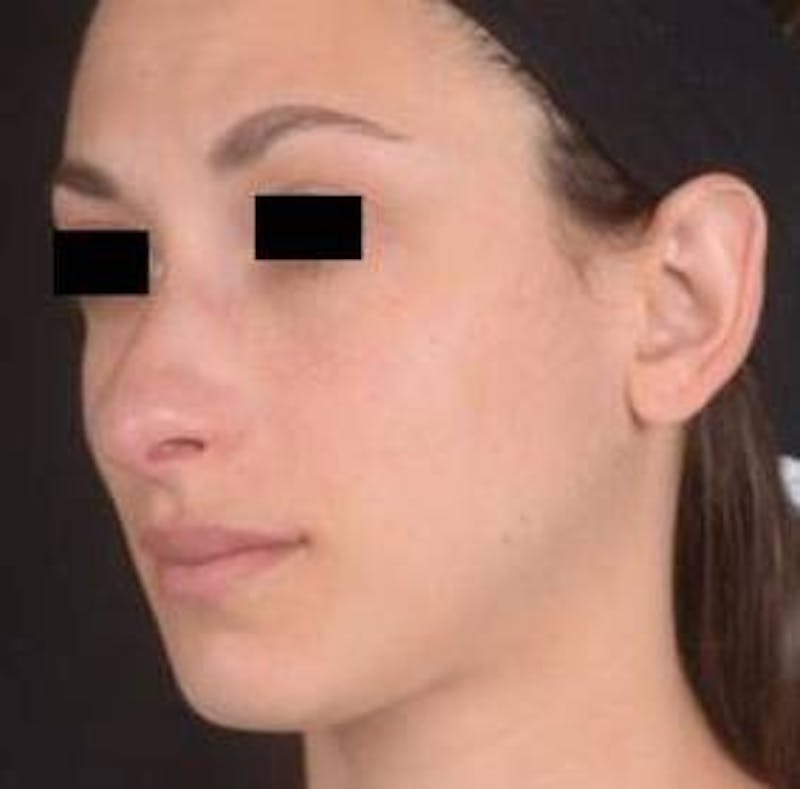 Rhinoplasty Before & After Gallery - Patient 111055 - Image 7