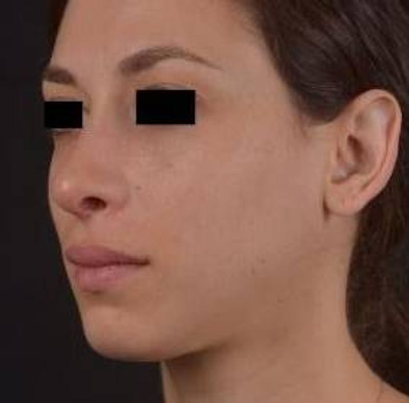 Rhinoplasty Before & After Gallery - Patient 111055 - Image 8