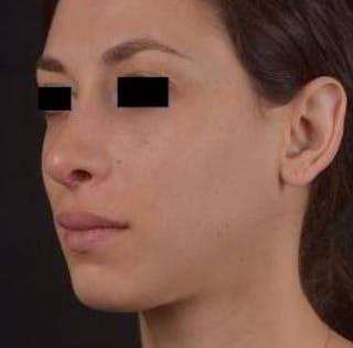 Rhinoplasty Before & After Gallery - Patient 111055 - Image 8